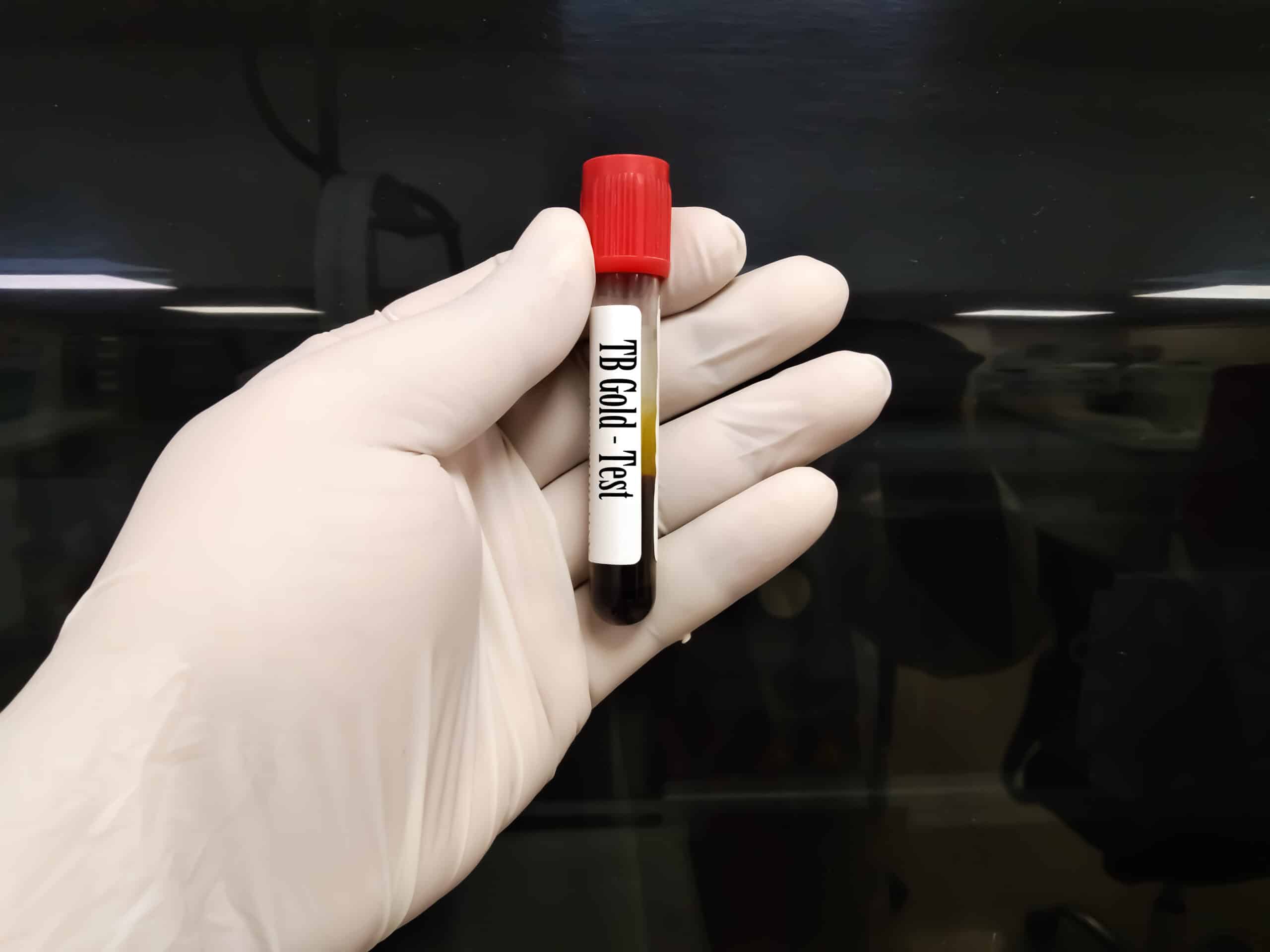 TB Gold Blood Test (tuberculosis test) Test Smartly Labs