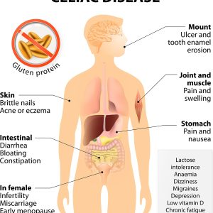 infographic showing symptoms of celiac