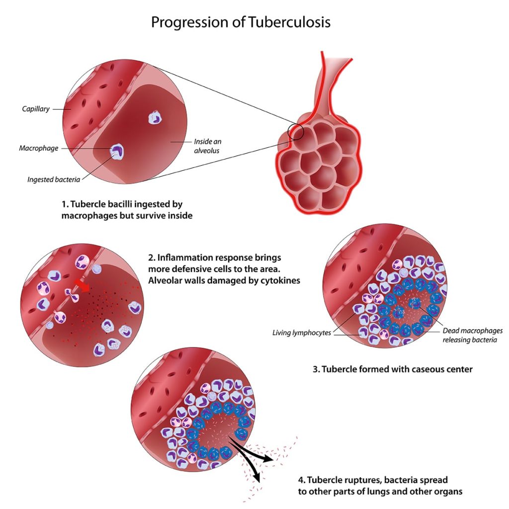 tb-gold-blood-test-tb-test-smartly-labs