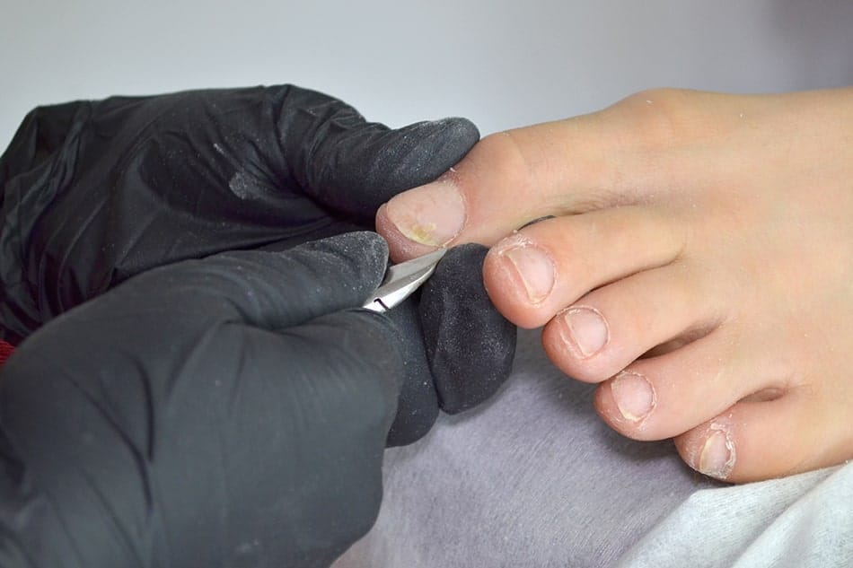 Someone taking a sample of a toenail