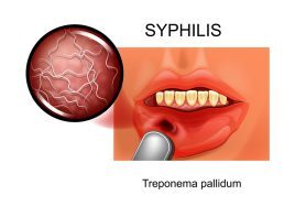 Syphilis Standard Test RPR (Rapid Plasma Reagin)